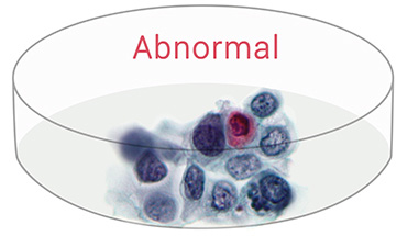 abnormal cells - advanced