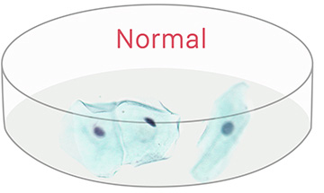 abnormal cells - mild